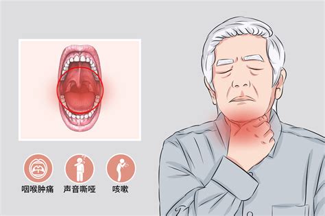链球菌性咽喉炎 .
